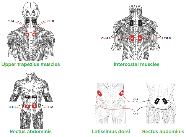 improving-activation-of-accessory-respiratory-muscles-with-nmes